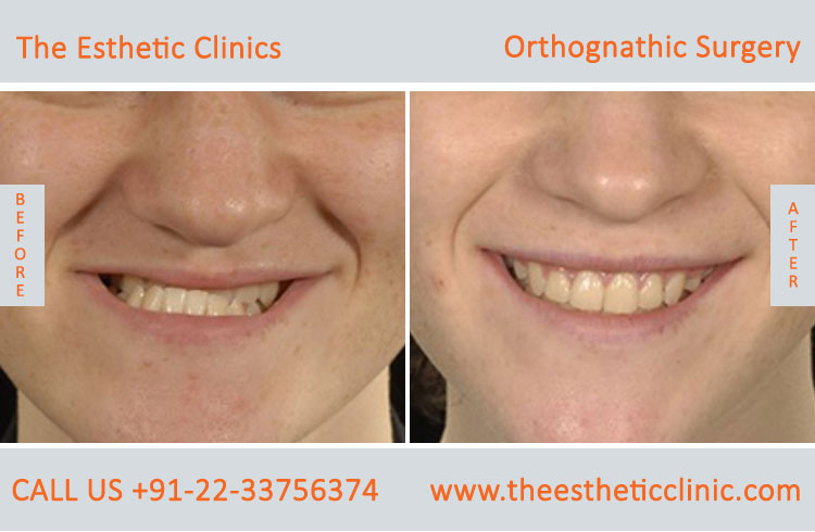 Orthognathic Surgery, Jaw Correction Surgery before after photos in mumbai india (8)